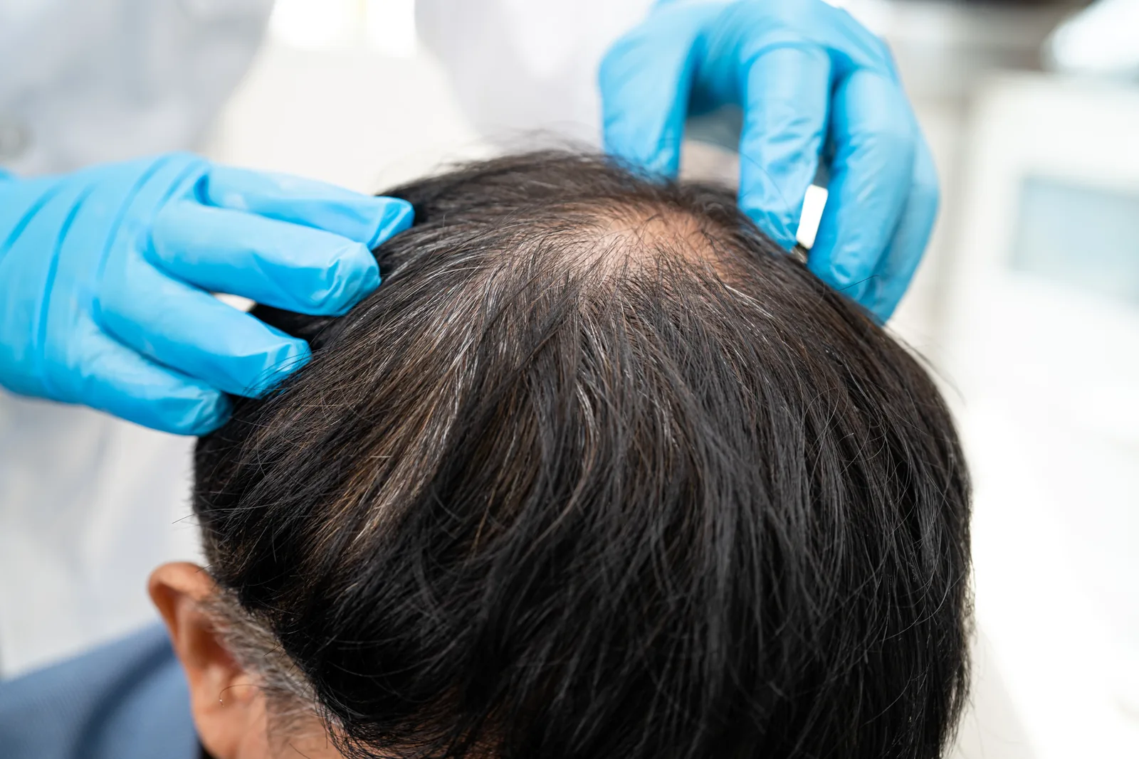 Arzt untersucht Haarausfall und Glatzenbildung – Haarpraxis Behandlung im ADEVE Salon