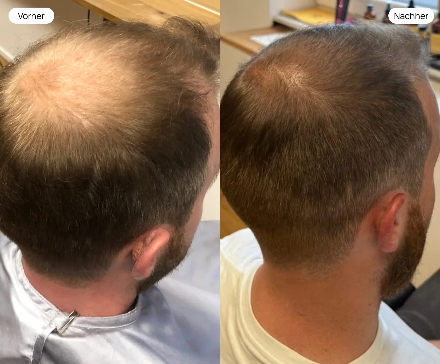 Vorher Nachher: Starker männlicher Haarausfall – sichtbares Haarwachstum nach ADEVE Methode