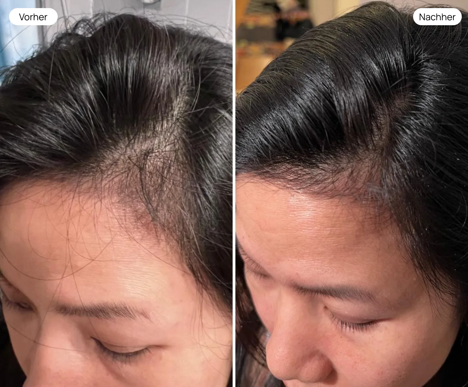 Vorher Nachher: Haarausfall bei Frauen – Kopfhaut nach ADEVE Behandlung deutlich erholt